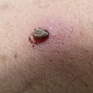 A tick found on one of our instructors